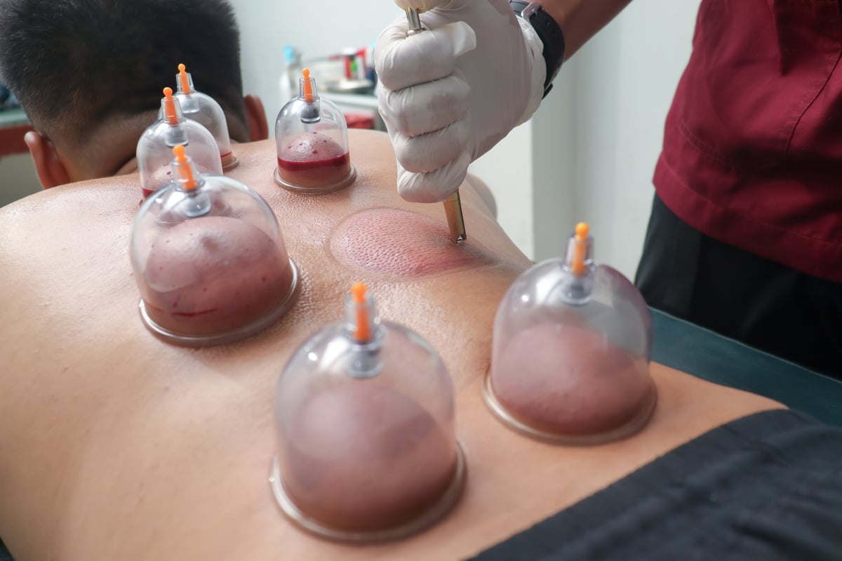 Male therapist performing cupping therapy on client in a professional session