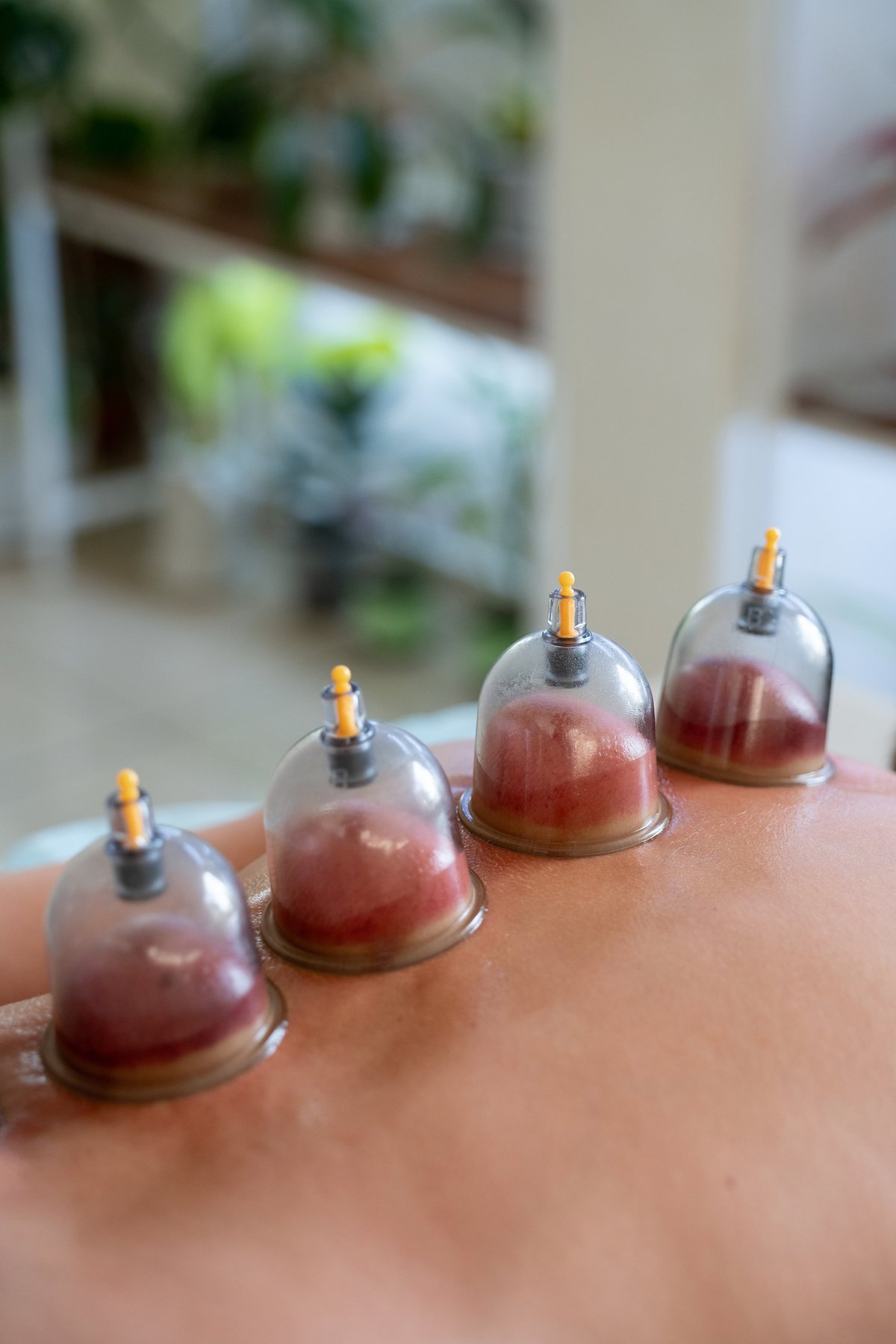 Close-up of vacuum cupping therapy on a person's back, promoting blood flow and muscle relaxation